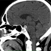 Tomografia axial computada de silla turca (Hipofisis) contrastada. EN. Codigo  CUPS 879116-C (2022)