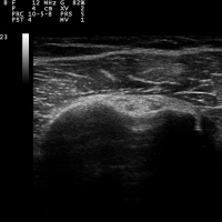 Ecografia articular de hombro. 881610 Idime