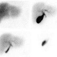 Gamagrafia hepatobiliar. 920702 Idime (2024)