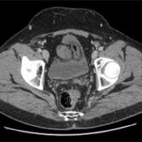 Tomografia axial computada simple de pelvis. 879460 Idime
