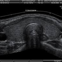 Ecografia diagnostica de tiroides con transductor de 7 MHZ o mas. 881141 Idime