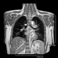 Resonancia nuclear magnetica de torax con contraste. 883301. Idime
