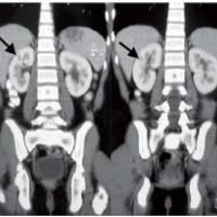 Tomografia computada de vias urinarias (UROTAC)  879430. Idime (2024)