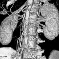 Tomografia computada de vasos. Aorta abdominal. 879901   Idime (2024)