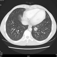 Tomografia axial computada con contraste de torax. 879301 Idime