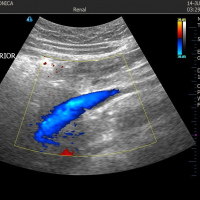 Ecografia doppler de vena cava a color. 882252 Idime