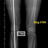 Radiografias comparativas de extremidades inferiores.873443 Idime