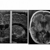 Ecografia diagnostica cerebral transfotanelar con transductor de 7 MHZ o mas. 881112 Idime
