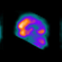 Gamagrafia spect cerebral. 920105 Idime (2024)