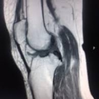 Resonancia nuclear magnetica  de sistema musculoesqueletico con contraste. 883590. Idime