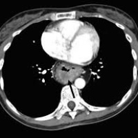 Tomografia computada de torax -score de calcio por escanografia. 879301. Idime (2024)