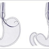 Dilatacion esofagica neumatica. Uniendoscopia (2023)