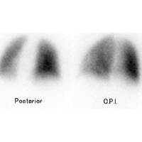 Gamagrafia pulmonar, perfusion. 920301 Idime (2024)