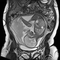 Resonancia nuclear magnetica obstetrica. EN. Codigo 883442 (2022)