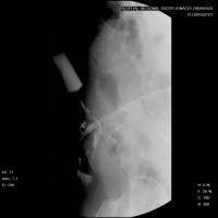 Sinografia o fistulografia de pared toracica. 876500  Idime