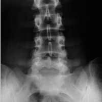 Radiografia de columna lumbosacra. 871040 Idime