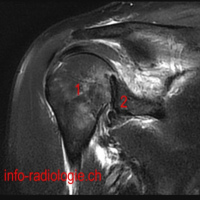 Resonancia nuclear magnetica de articulaciones de miembro superior (especifico) 883512 Idime. (2022)