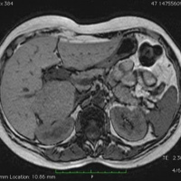 Resonancia nuclear magnetica con angiografia de pelvis.883909 Idime