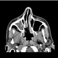 Tomografia axial computada de rinofaringe (cortes axiales y coronales). 879132 Idime