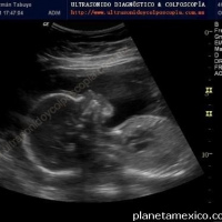 Ecografia obstetrica con perfil biofisico.881434 Idime