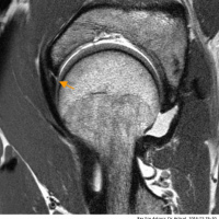 Artrotac de cadera. 99902869. Idime (2022)