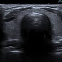 Ecografia de tiroides con transductor de 7 Mhz o mas. EN. Codigo CUPS 881141 (2022)