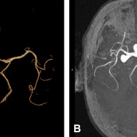 Tomografia computada de vasos. Carotidea y vertebral. 879901  Idime (2024)