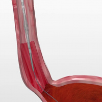 Dilatacion con bujias de savary. Uniendoscopia (2023)