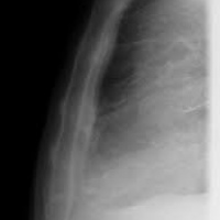 Radiografia de esternon. 871112. Idime