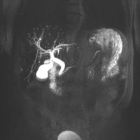 Resonancia nuclear magnetica de vias biliares con contraste. EN. Codigo 883430 C (2022)