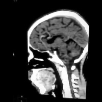 Tomografia computada de craneo simple. EN. Codigo CUPS 879111 (2022)