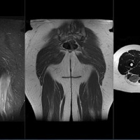 Resonancia nuclear magnetica de miembro inferior sin incluir articulaciones con contraste. 883521. Idime