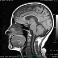 Resonancia nuclear magnetica de senos paranasales o cara. 883110 Idime. (2022)