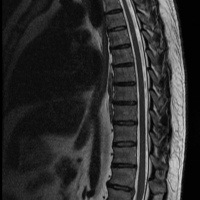 Resonancia nuclear magnetica de columna toracica simple 883220. Idime (2022)