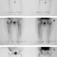 Gamagrafia con unidosis leucocitos marcados. 920505 Idime (2024)