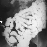 Radiografia de transito intestinal convencional.872101  Idime