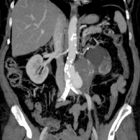 Angiotomografia de aorta abdominal. 879901. Idime (2022)