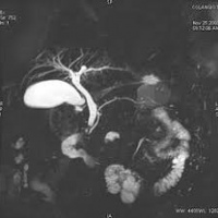 Resonancia nuclear magnetica de vias biliares simple y contrastada. EN. Codigo 883430 SC (2022)