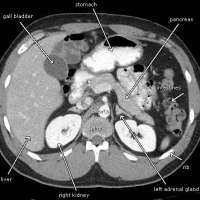 Tomografia axial computada simple de abdomen superior. 879410. Idime