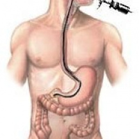 Esofago gastroduodenoscopia con extraccion de cuerpo extraño. EN. Codigo CUPS 441301 (2022)