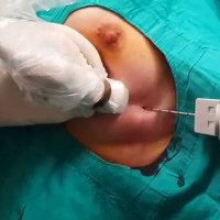 Biopsia de mama con aguja tru-cut (incluye la aguja). 851102.Idime (2024)