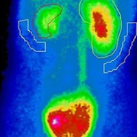 Gamagrafia de pool sanguineo. Compartimentos vasculares. 920510 Idime (2024)