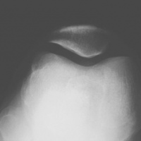 Radiografias axiales de rotula o longitud de miembros inferiores. 873426  Idime