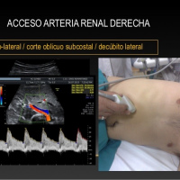 Ecografia doppler de arterias renales a color. 882222. Idime