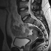 Resonancia nuclear magnetica de columna sacroiliaca simple 883232. Idime (2022)