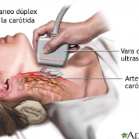 Duplex vasos perifericos cuello (carotidas, vertebrales, yugulares) a color. 882112  Idime