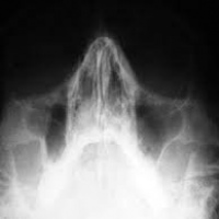 Radiografia de malar. 870104 Idime