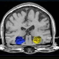 Resonancia nuclear magnetica simple de cerebro con volumetria de hipocampos. Idime
