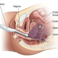 Ecografia pelvica transvaginal. Ecografias Bogota (Mandalay)