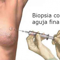 Biopsia por puncion con aguja fina de mama. 851101 Idime (2024)
